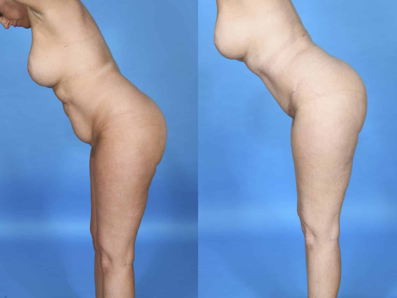 Before and After Image: Body Contouring - other