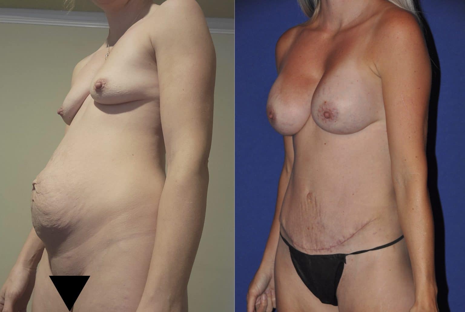 Before and After Image: Body Contouring - left-front-oblique