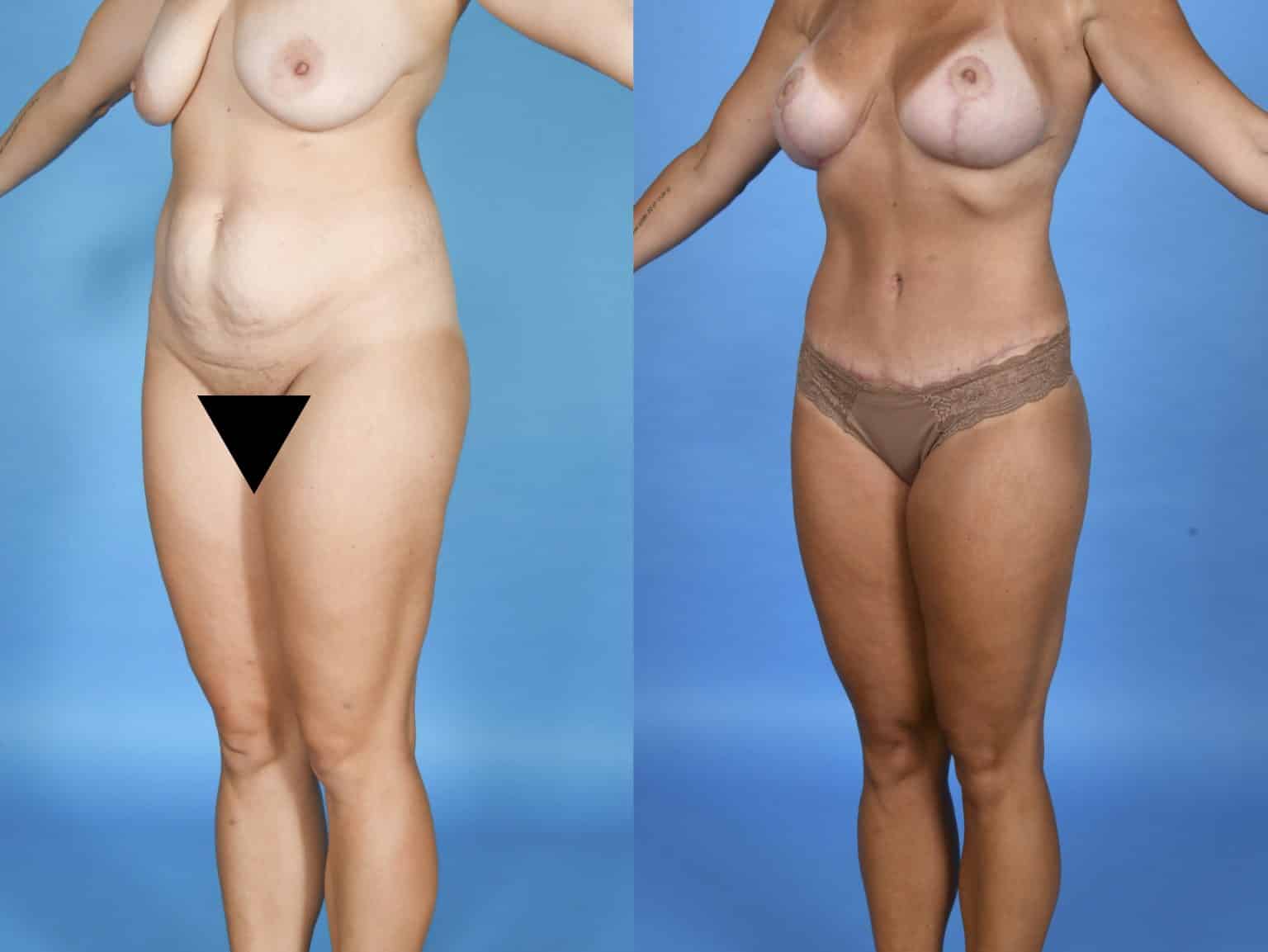 Before and After Image: Body Contouring - left-front-oblique