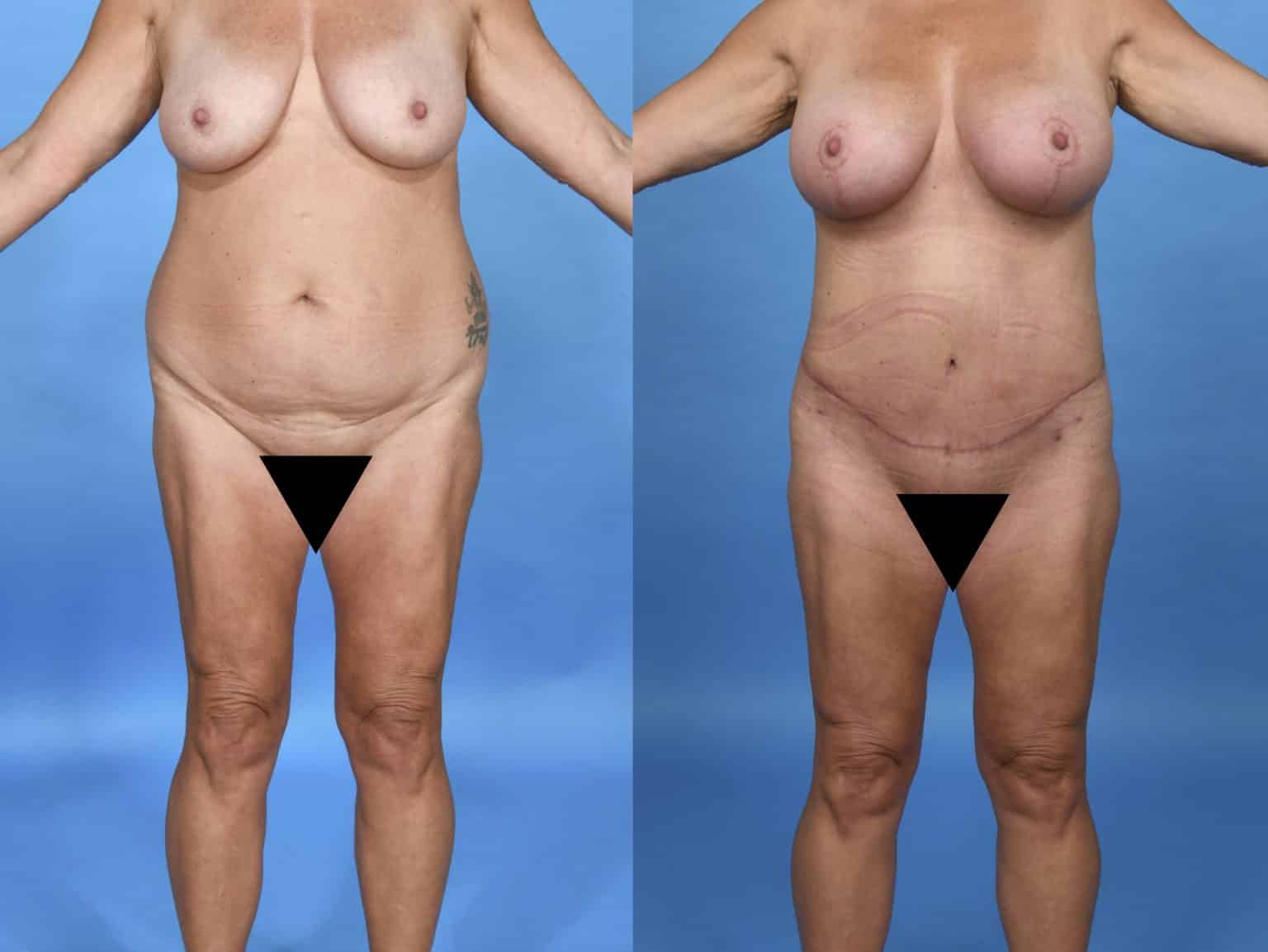 Before and After Image: Body Contouring - front