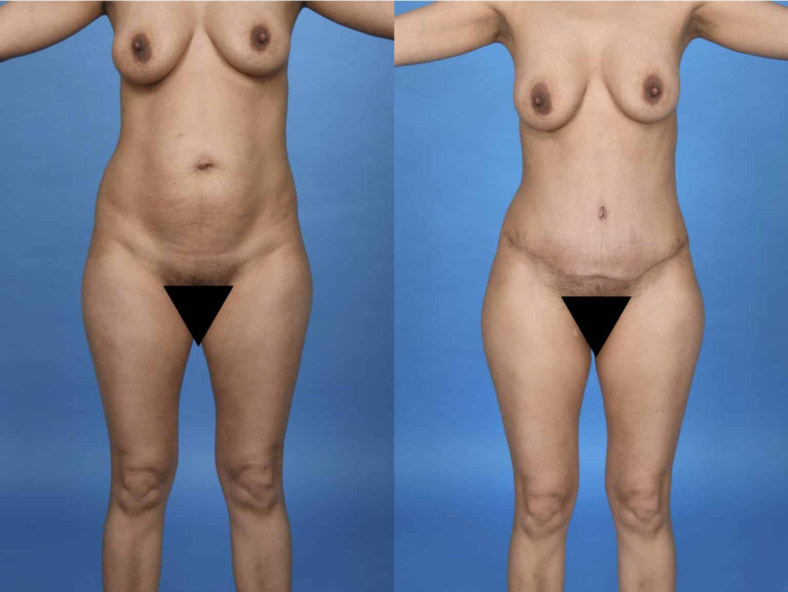 Before and After Image: Body Contouring - front