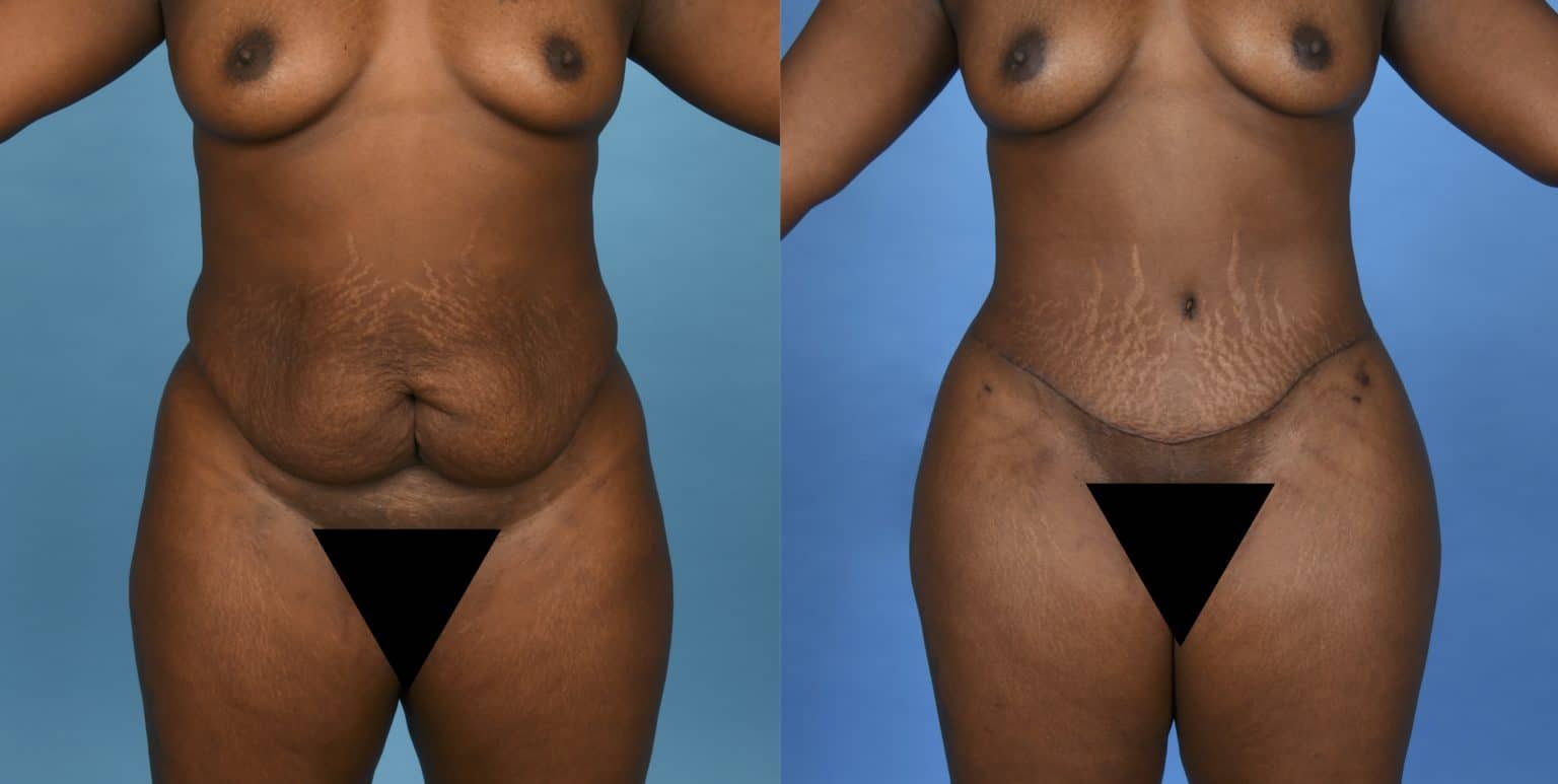 Before and After Image: Body Contouring - front