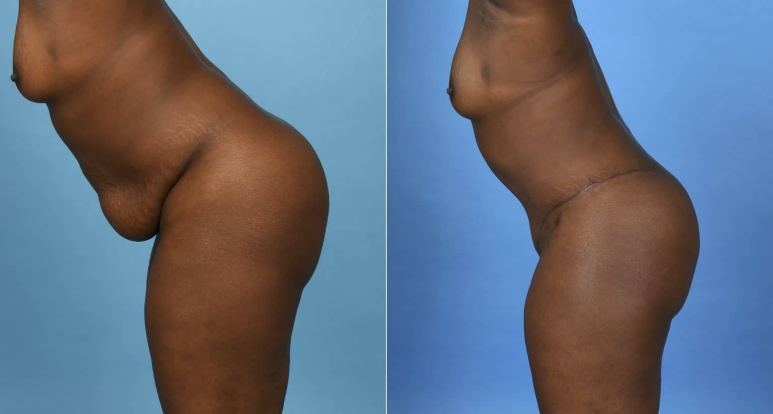 Before and After Image: Body Contouring - other