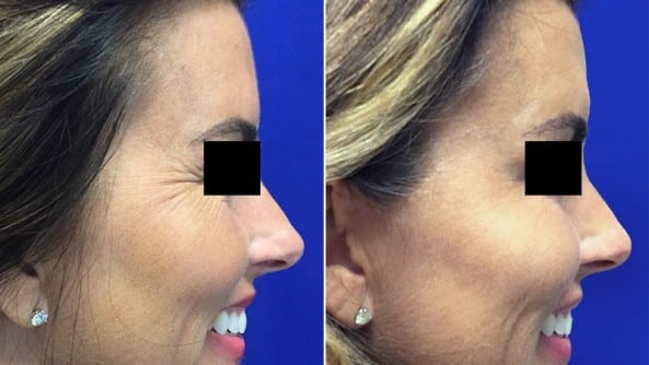 Before and After Image: Botox - right-side