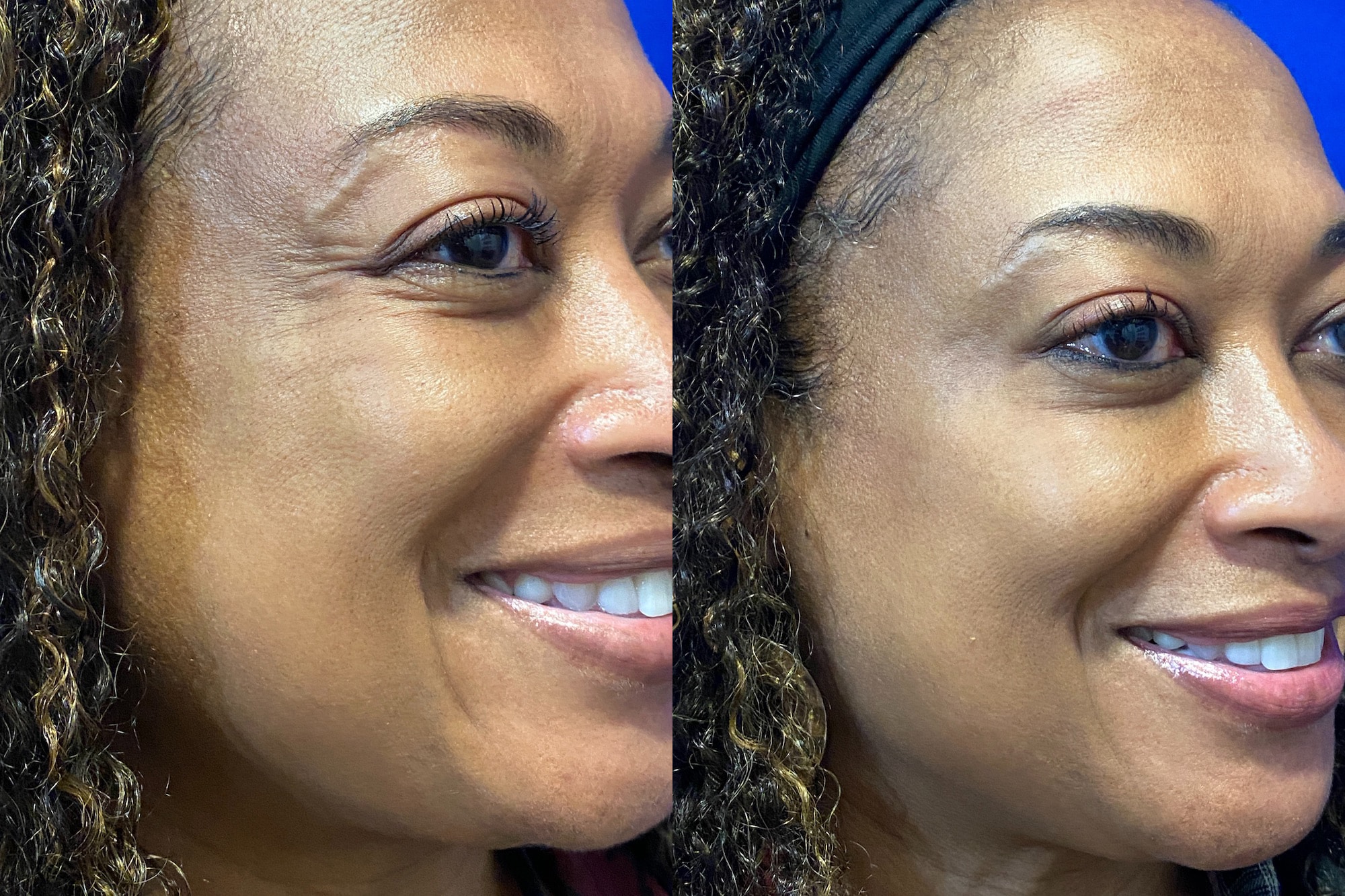 Before and After Image: Botox - right-front-oblique