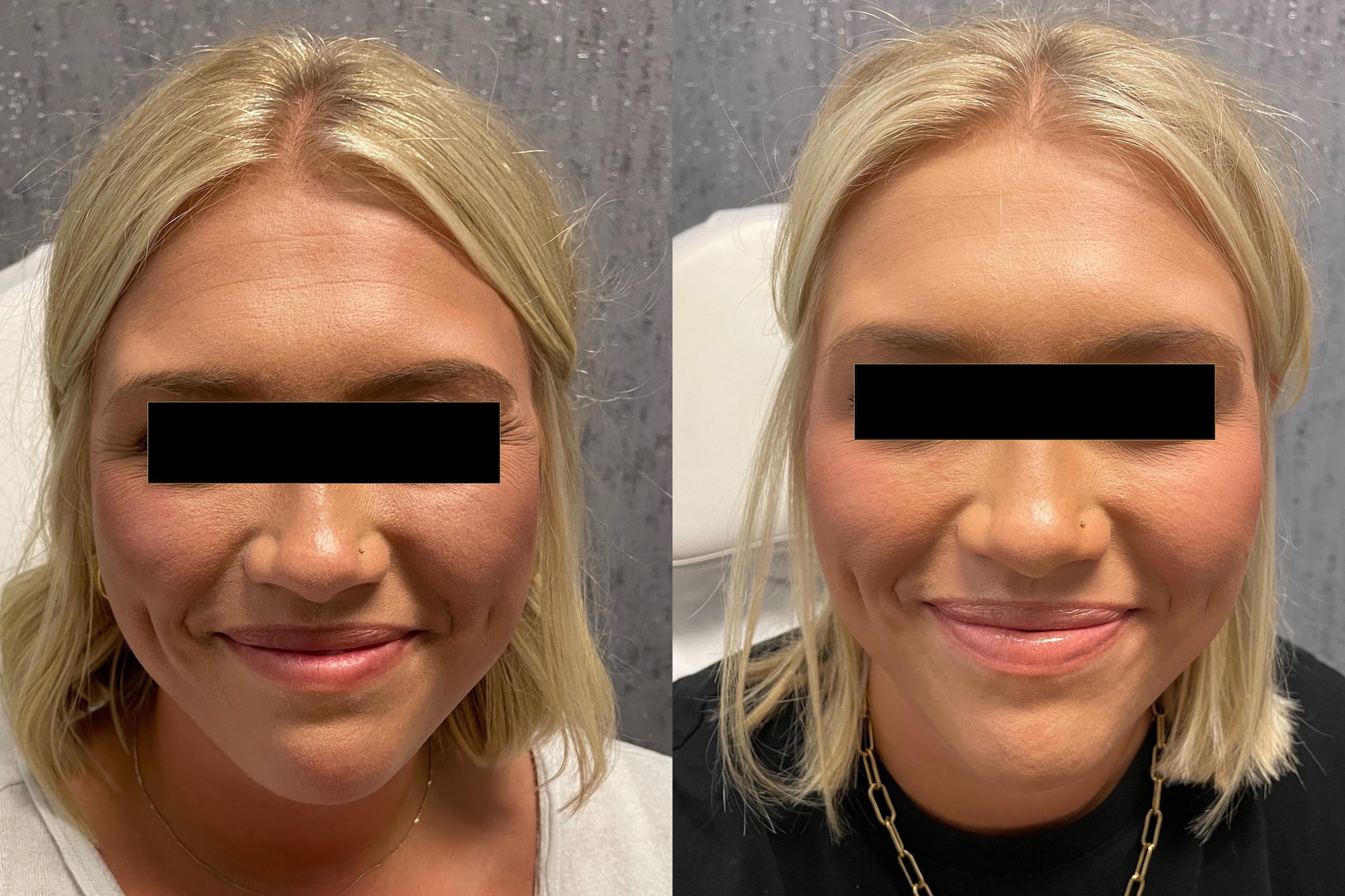 Before and After Image: Botox - front