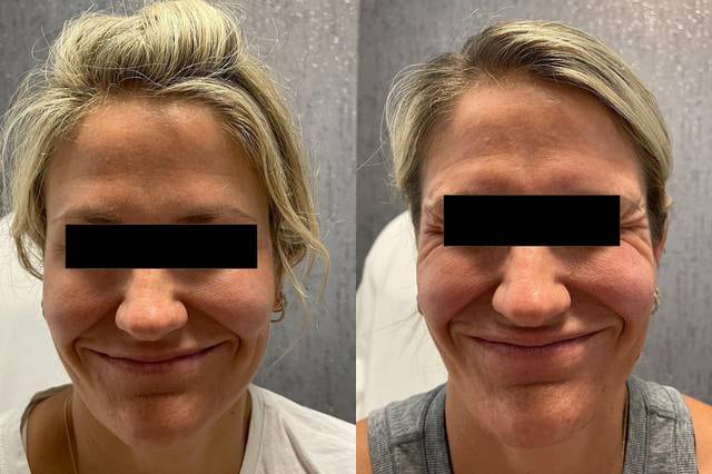 Before and After Image: Botox - front