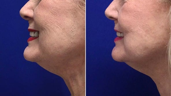 Before and After Image: Botox - left-side