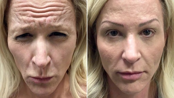 Before and After Image: Dermal Fillers/Botox - front