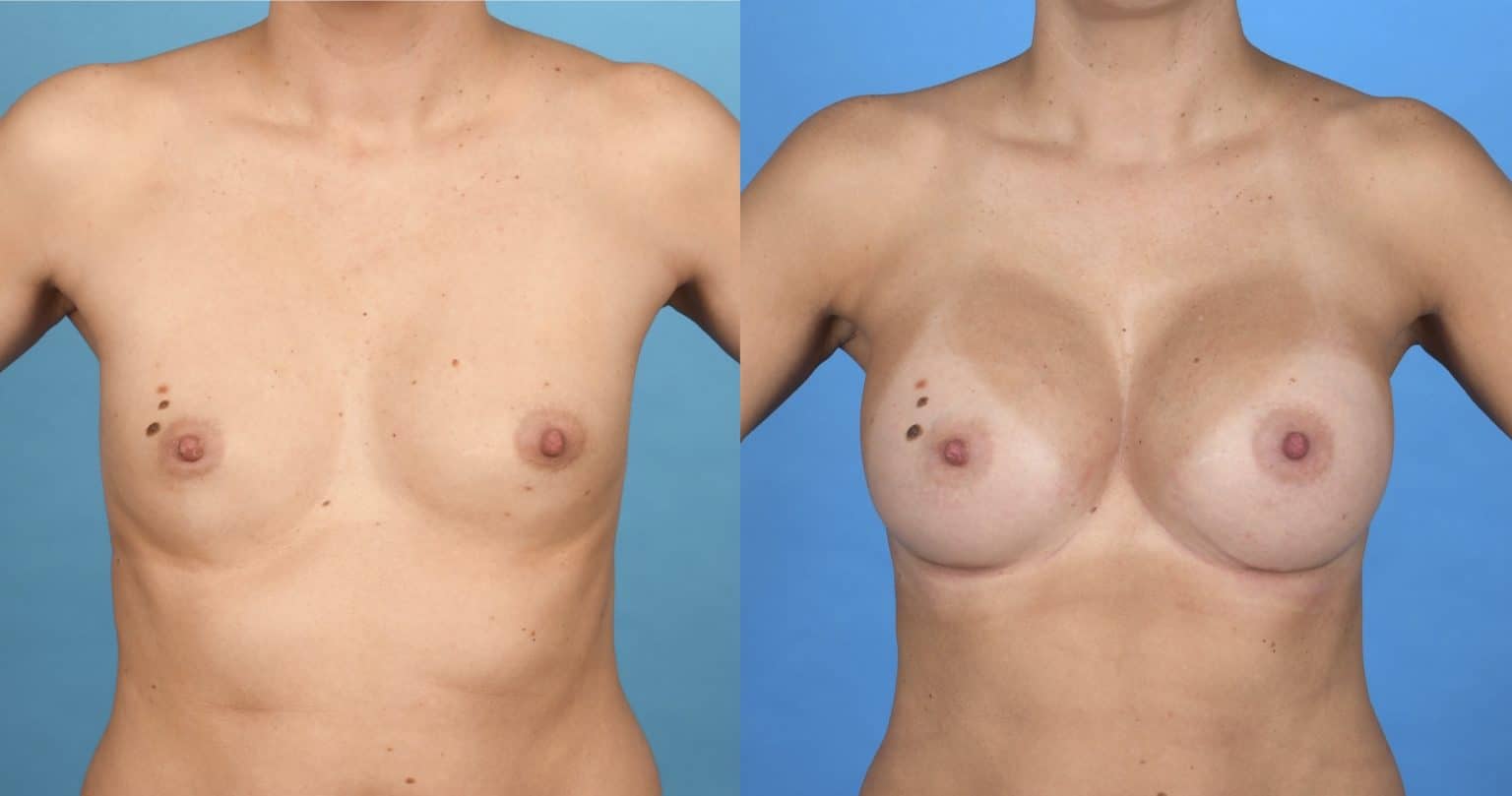 Before and After Image: Submuscular Silicone Breast Augmentation - front