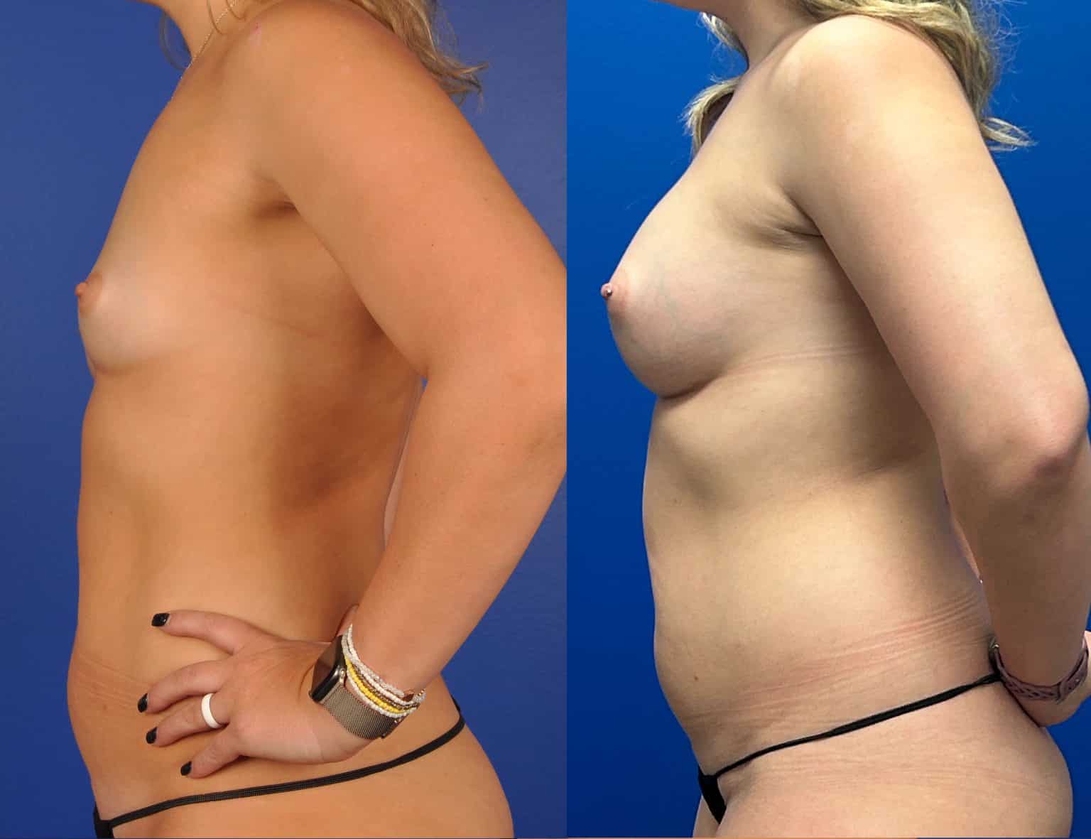 Before and After Image: Subfascial Silicone Breast Augmentation - left-side