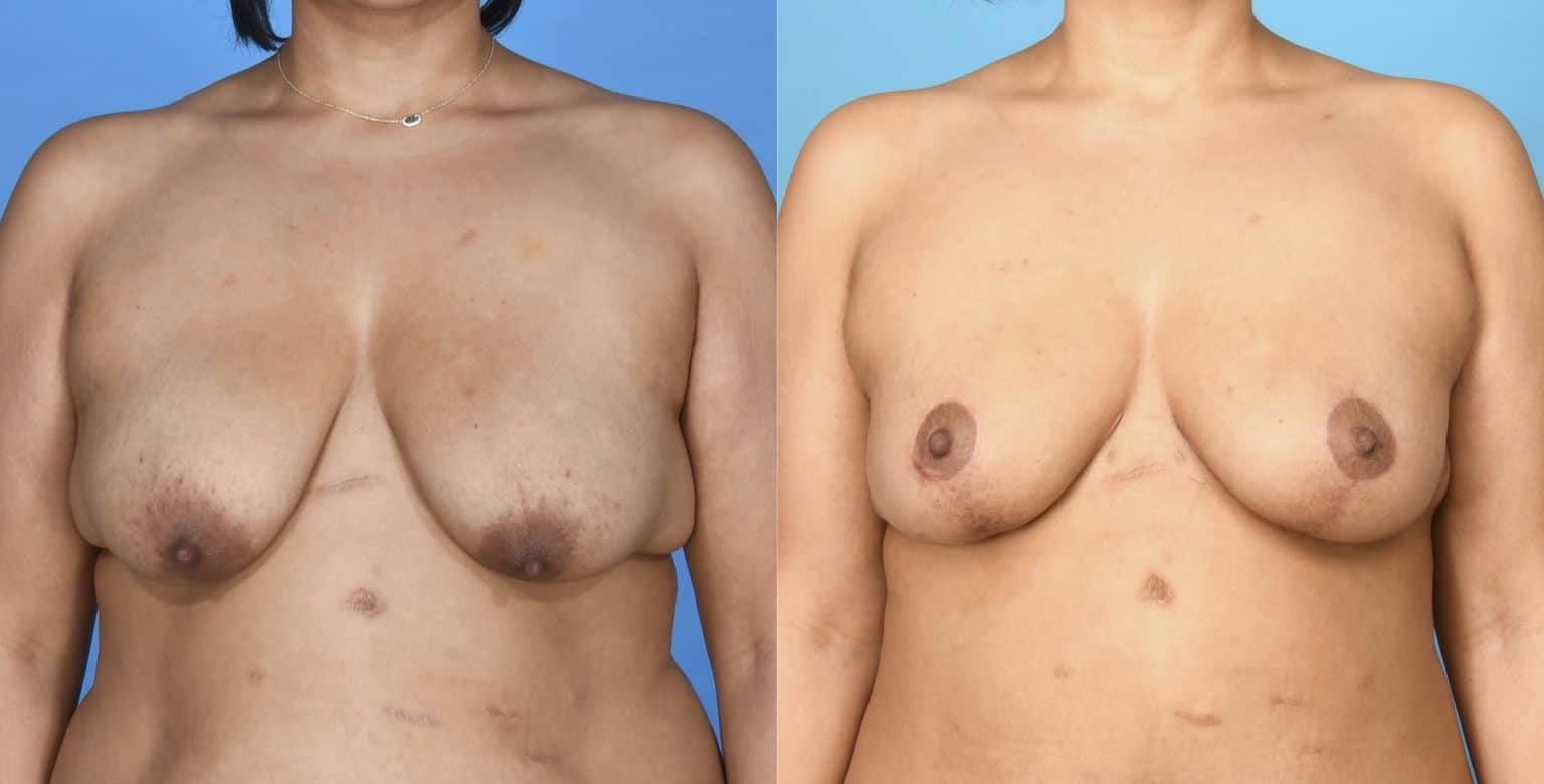 Before and After Image: Breast Lift (Mastopexy) - front