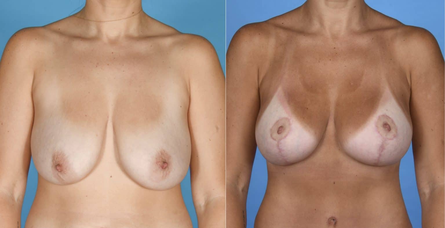 Before and After Image: Silicone Breast Augmentation with Mastopexy - front