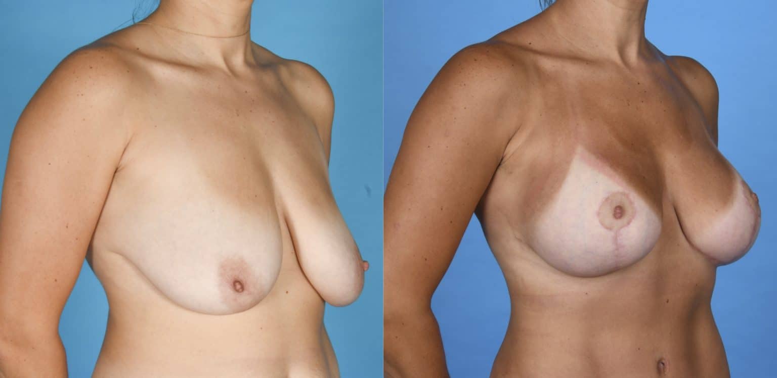 Before and After Image: Silicone Breast Augmentation with Mastopexy - right-front-oblique