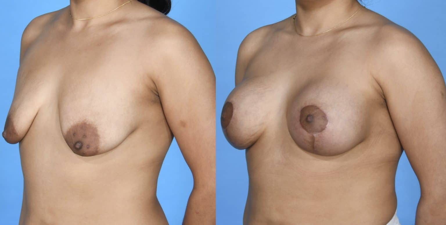 Before and After Image: Silicone Breast Augmentation with Mastopexy - left-front-oblique