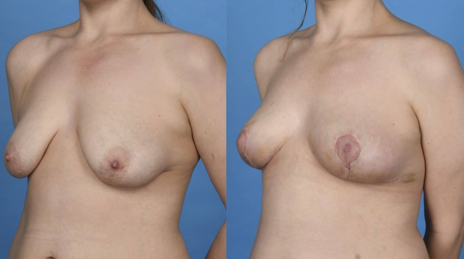 Before and After Image: Breast Lift (Mastopexy) - left-front-oblique