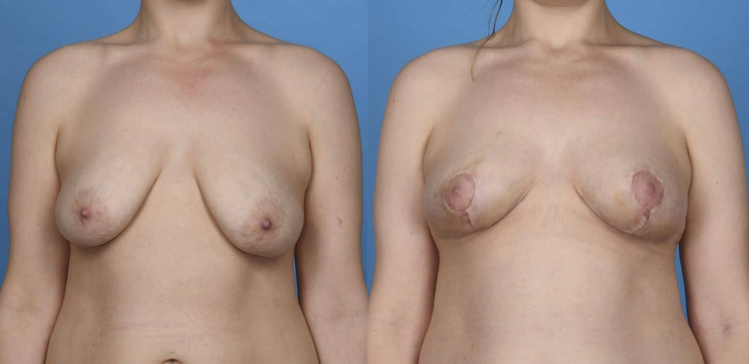 Before and After Image: Breast Lift (Mastopexy) - front