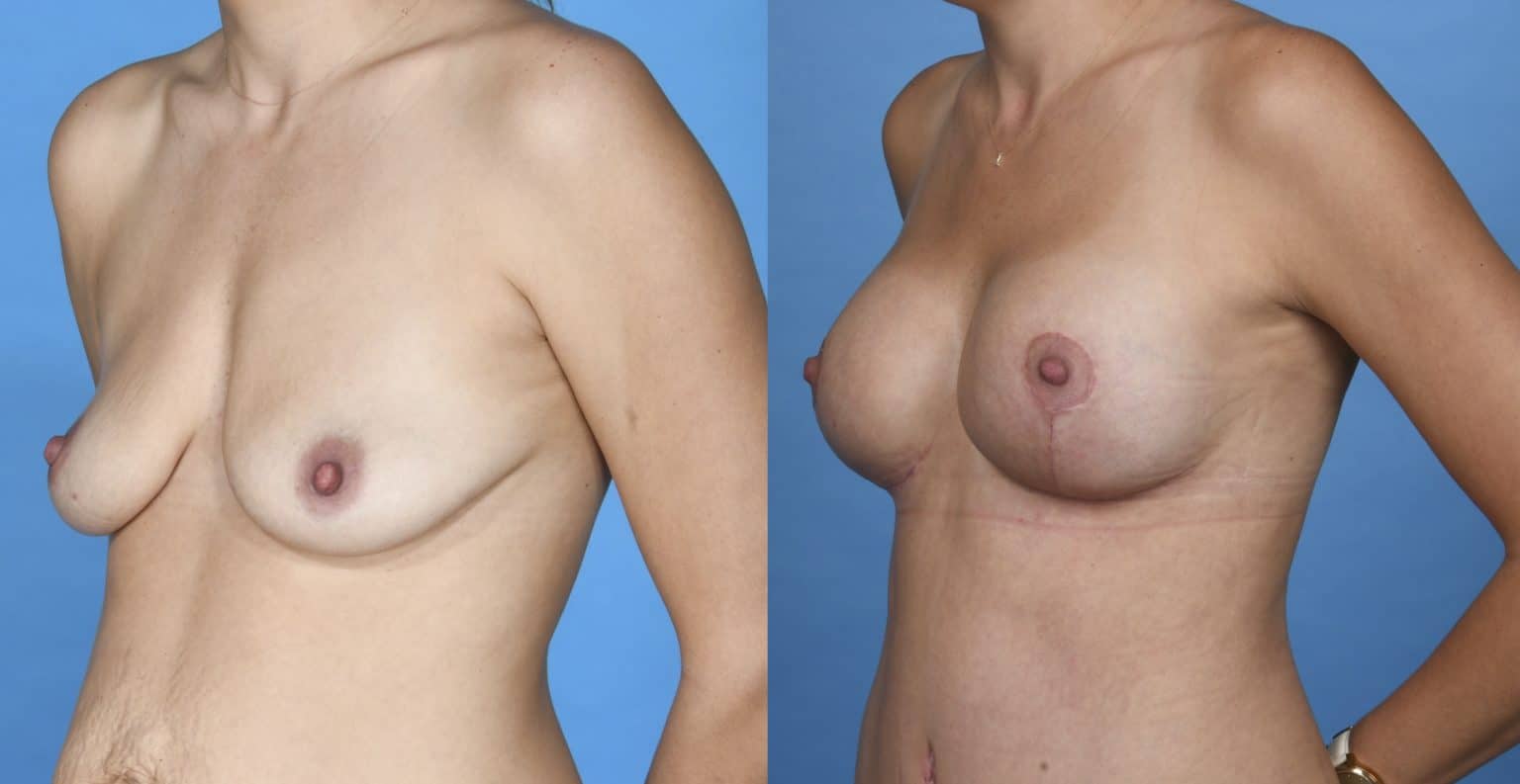 Before and After Image: Breast Augmentation Mastopexy - left-front-oblique