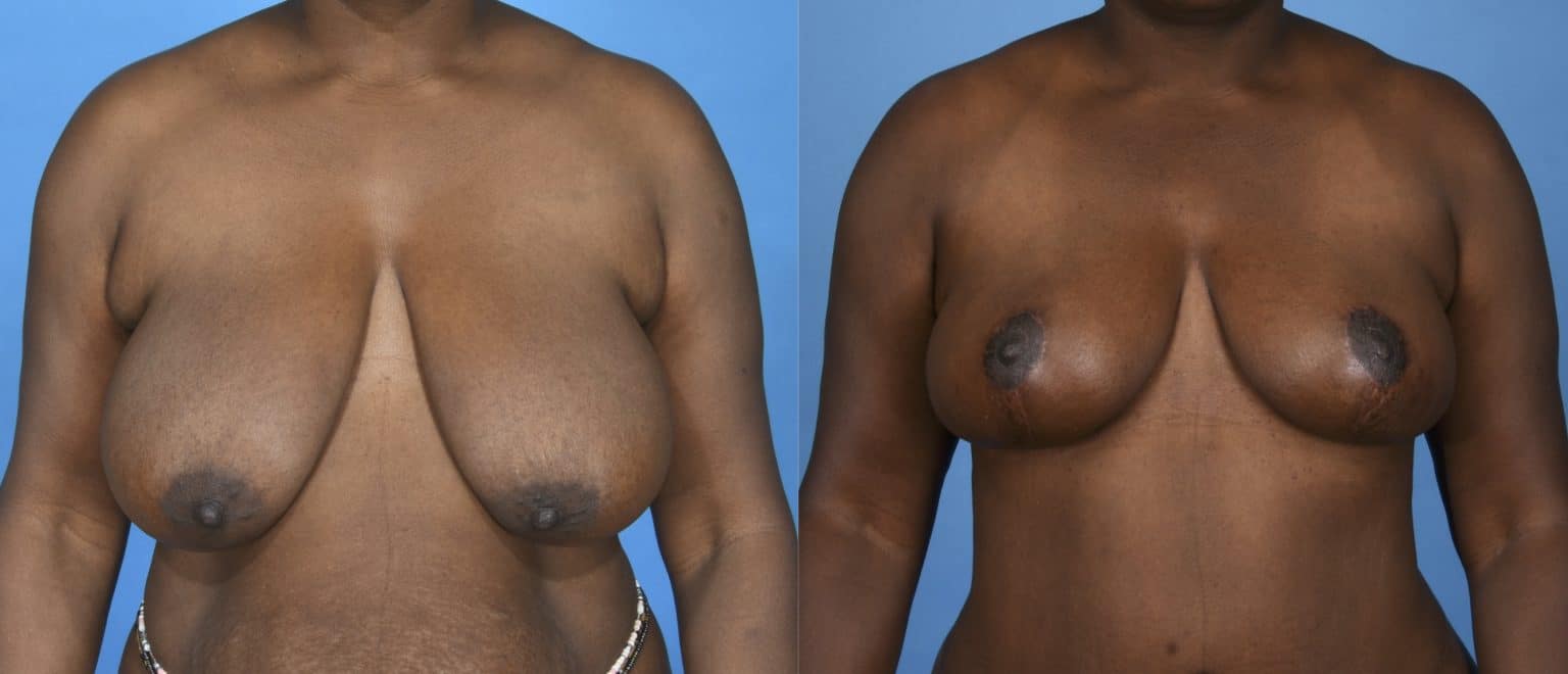 Before and After Image: Breast Reduction with Lift - front