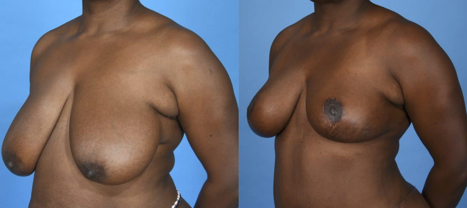 Before and After Image: Breast Reduction with Lift - left-front-oblique