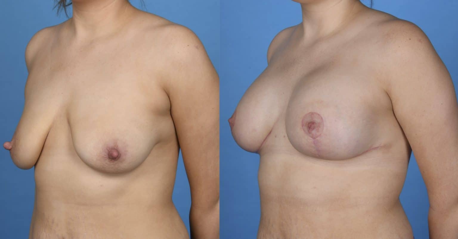Before and After Image: Breast Augmentation Mastopexy with Nipple Reduction - left-front-oblique