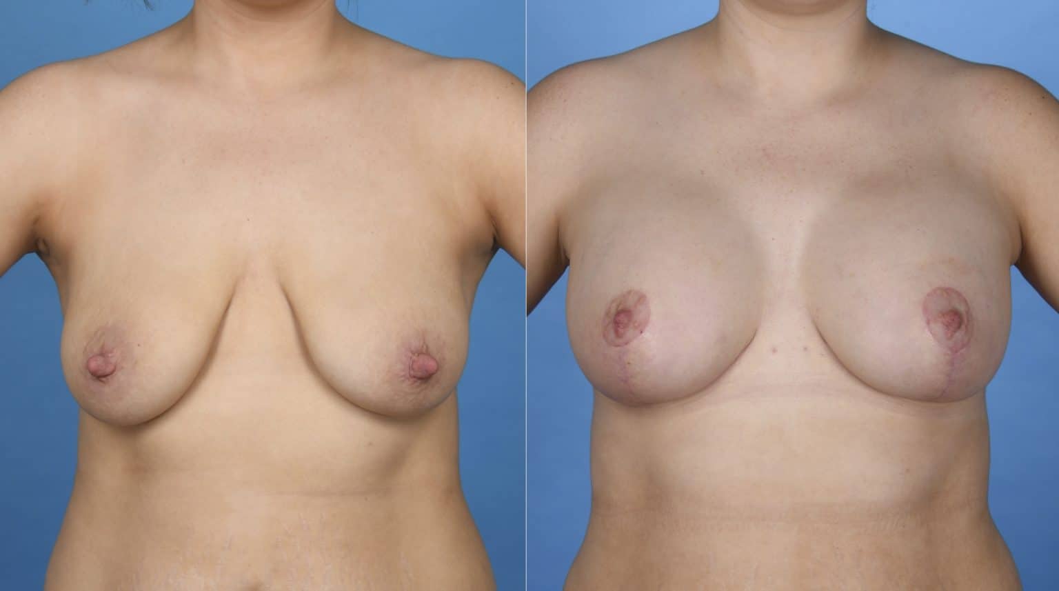 Before and After Image: Breast Augmentation Mastopexy with Nipple Reduction - front
