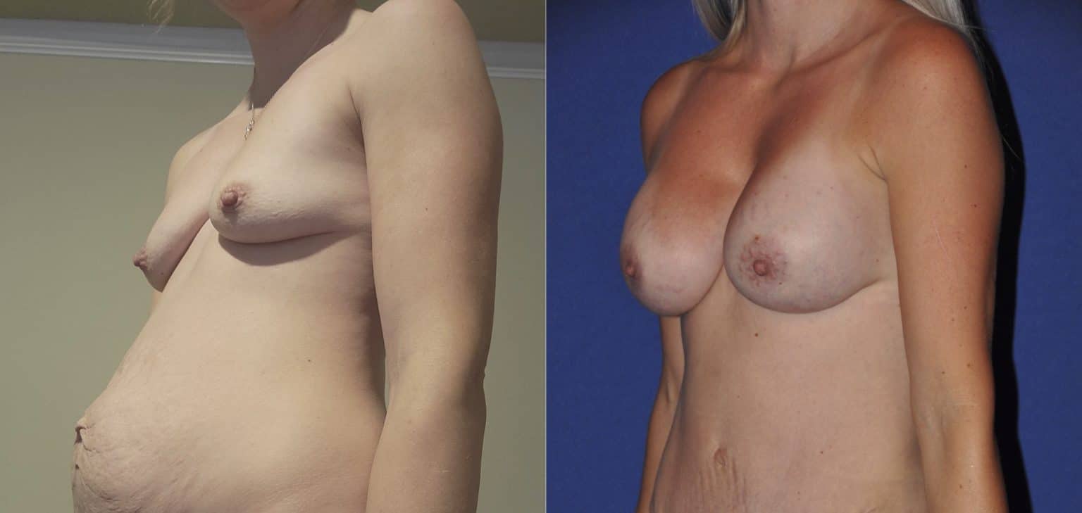 Before and After Image: Subfascial Silicone Breast Augmentation - left-front-oblique