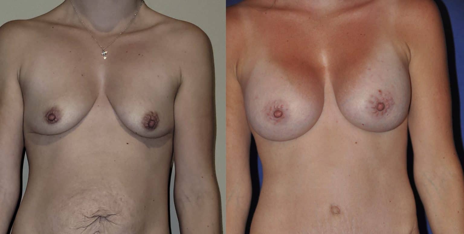Before and After Image: Subfascial Silicone Breast Augmentation - front