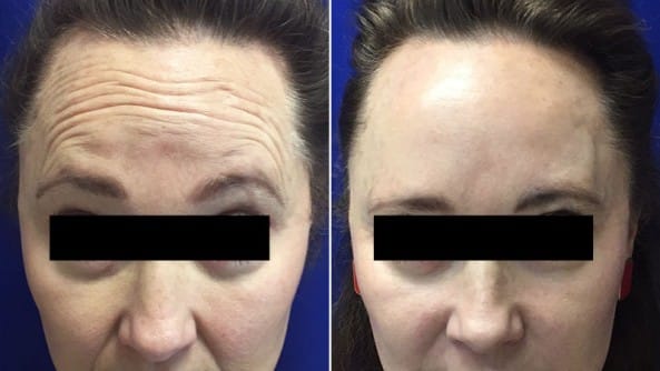 Before and After Image: Botox - front
