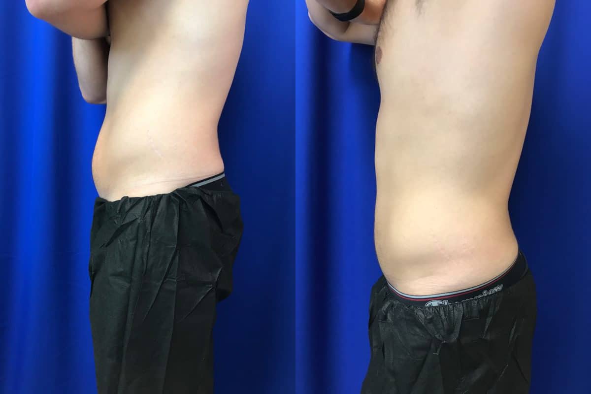 Before and After Image: CoolSculpting - left-side