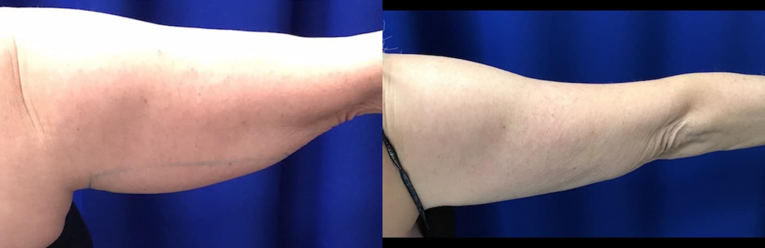 Before and After Image: CoolSculpting - back