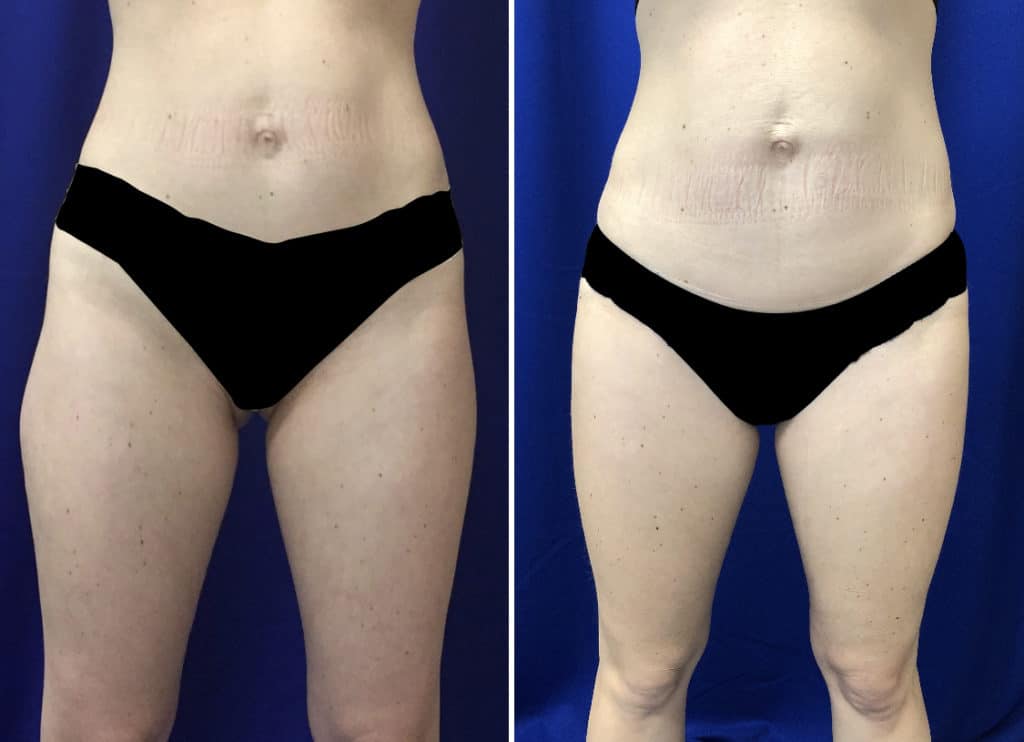 Before and After Image: CoolSculpting - front
