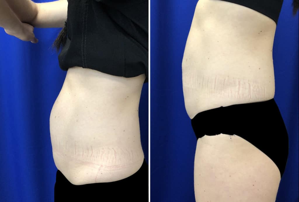 Before and After Image: CoolSculpting - left-side