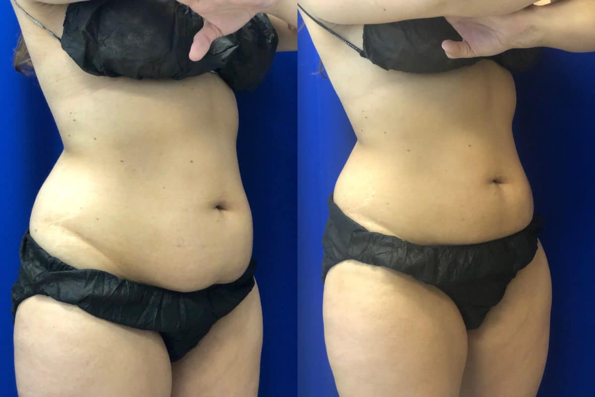 Before and After Image: CoolSculpting - right-front-oblique