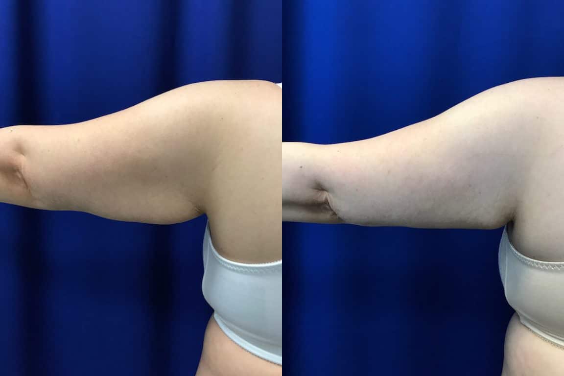 Before and After Image: CoolSculpting - back