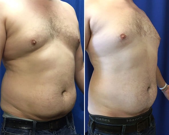 Before and After Image: CoolSculpting - right-front-oblique