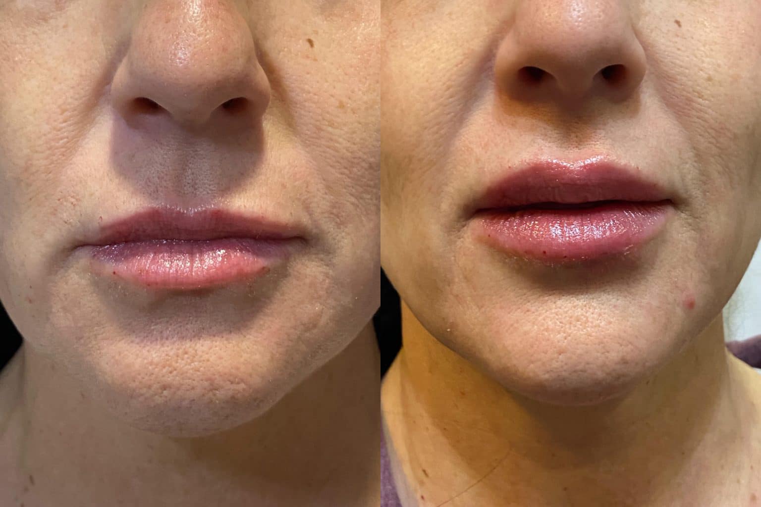 Before and After Image: Lip Filler - front
