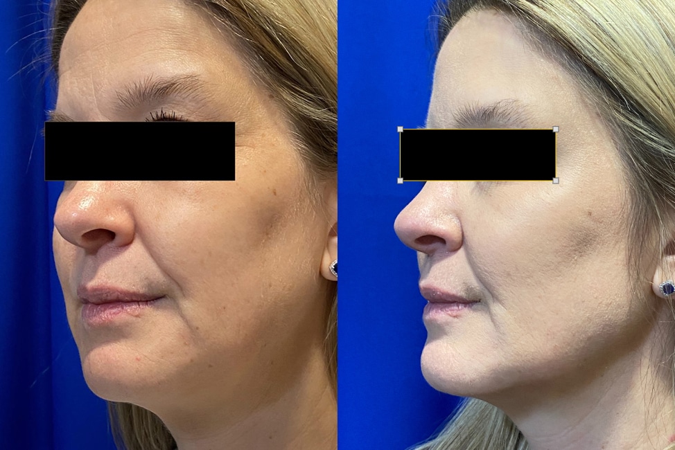 Before and After Image: Jawline Enhancement - left-front-oblique