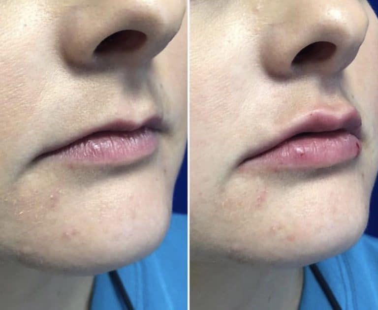 Before and After Image: Dermal Fillers - right-front-oblique