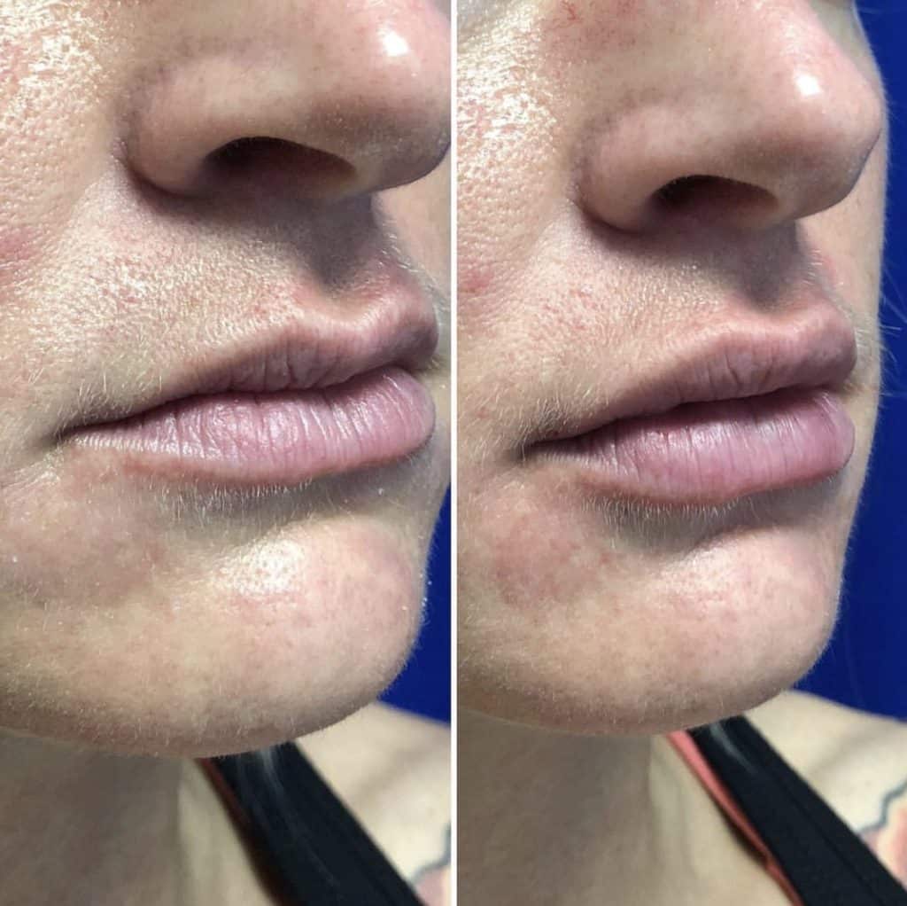 Before and After Image: Dermal Fillers - right-front-oblique