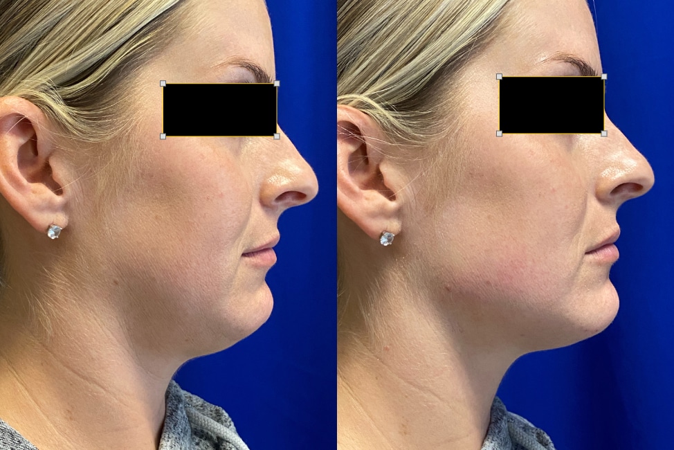 Before and After Image: Jawline Enhancement - right-side