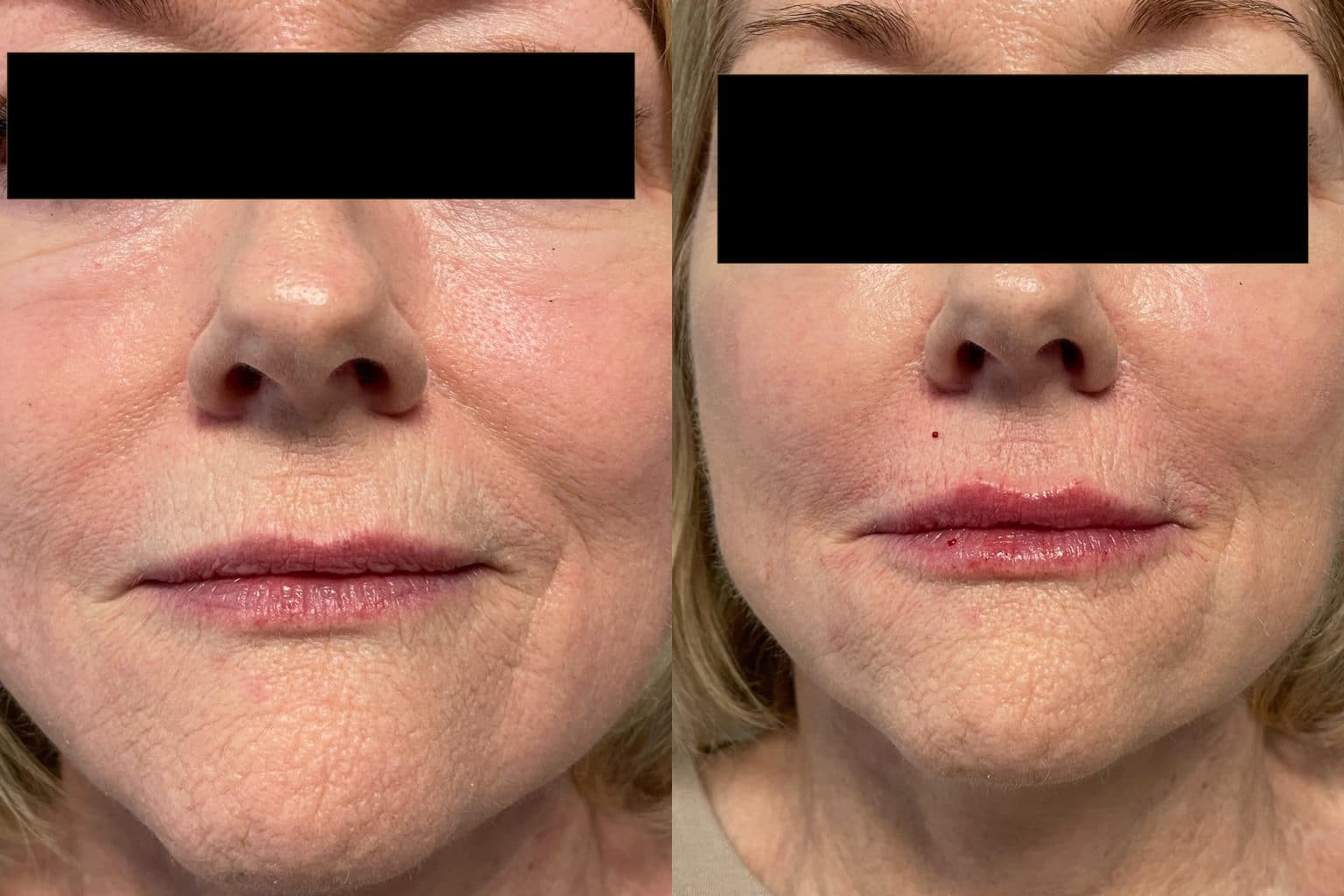 Before and After Image: Lip Filler - front
