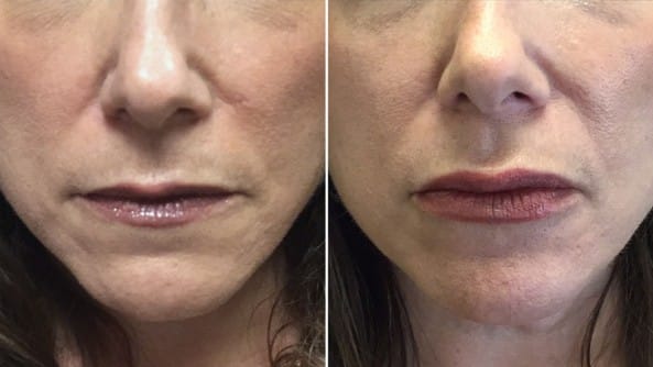 Before and After Image: Dermal Fillers - front