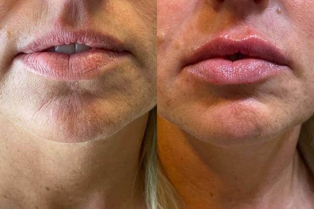 Before and After Image: Lip Filler - front