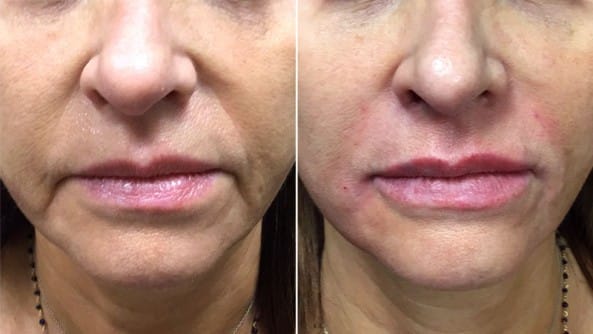 Before and After Image: Dermal Fillers - front