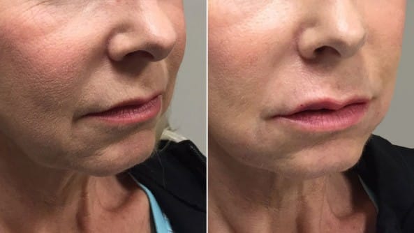 Before and After Image: Dermal Fillers - right-front-oblique