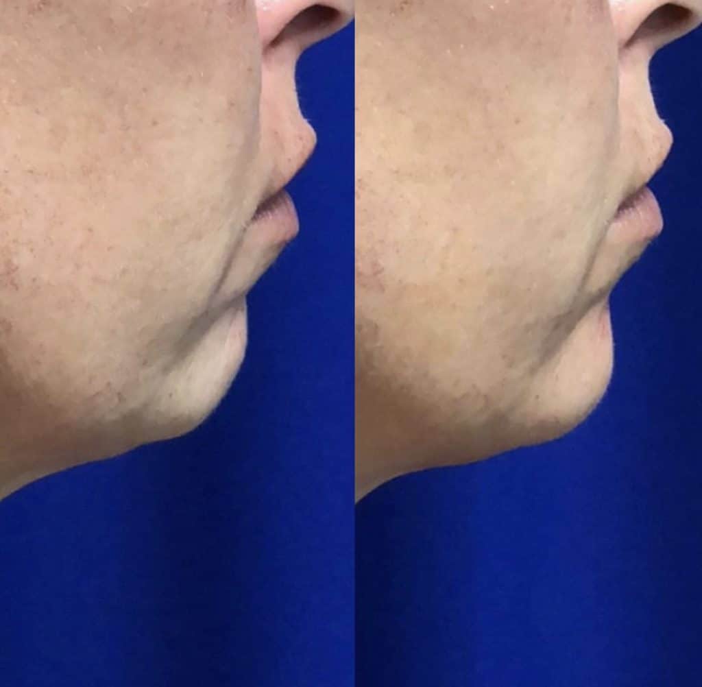 Before and After Image: Dermal Fillers - right-side