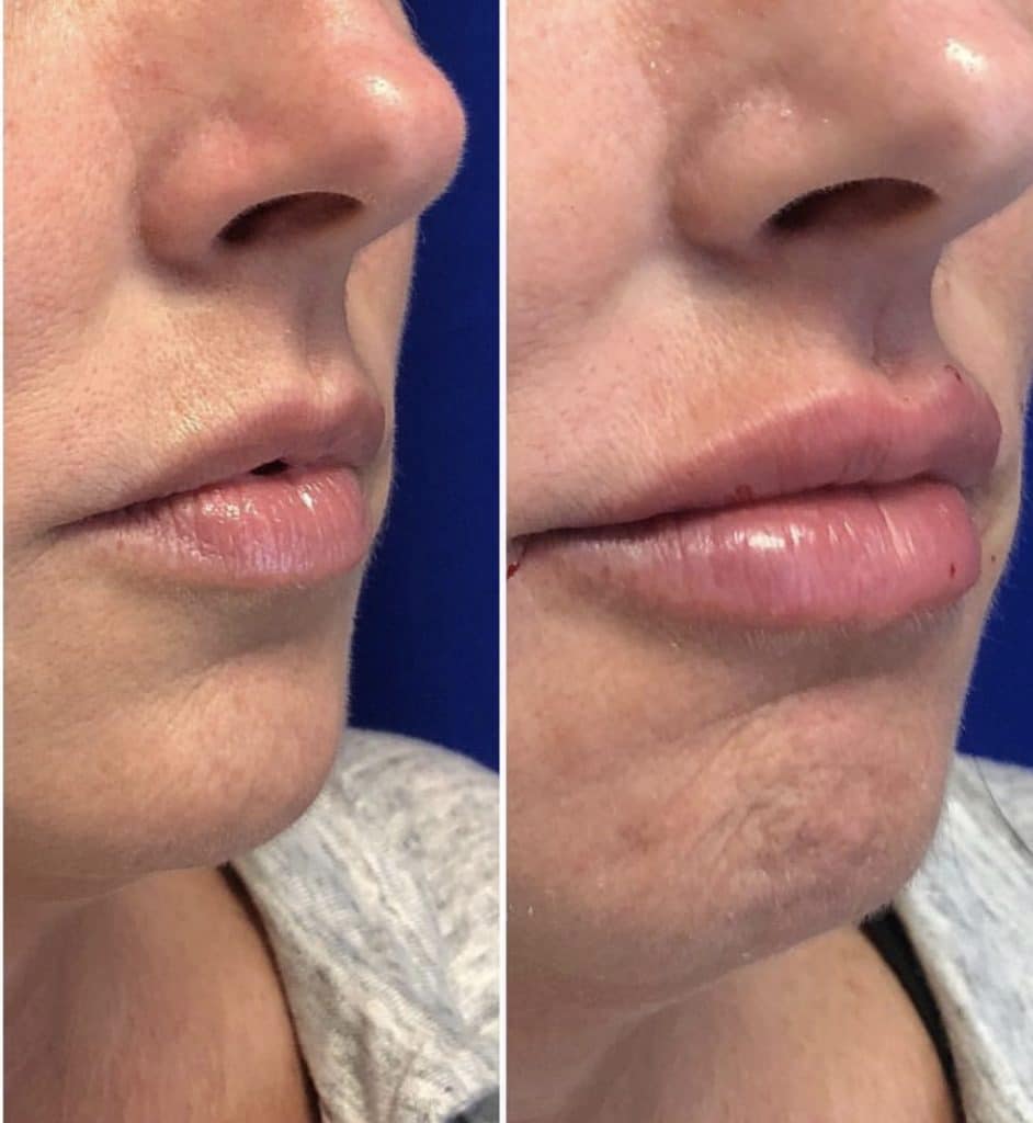 Before and After Image: Dermal Fillers - right-front-oblique