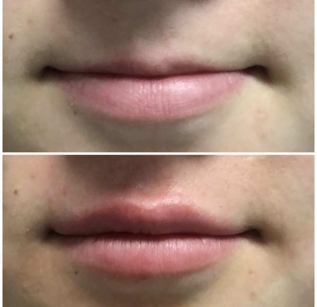 Before and After Image: Dermal Fillers - front