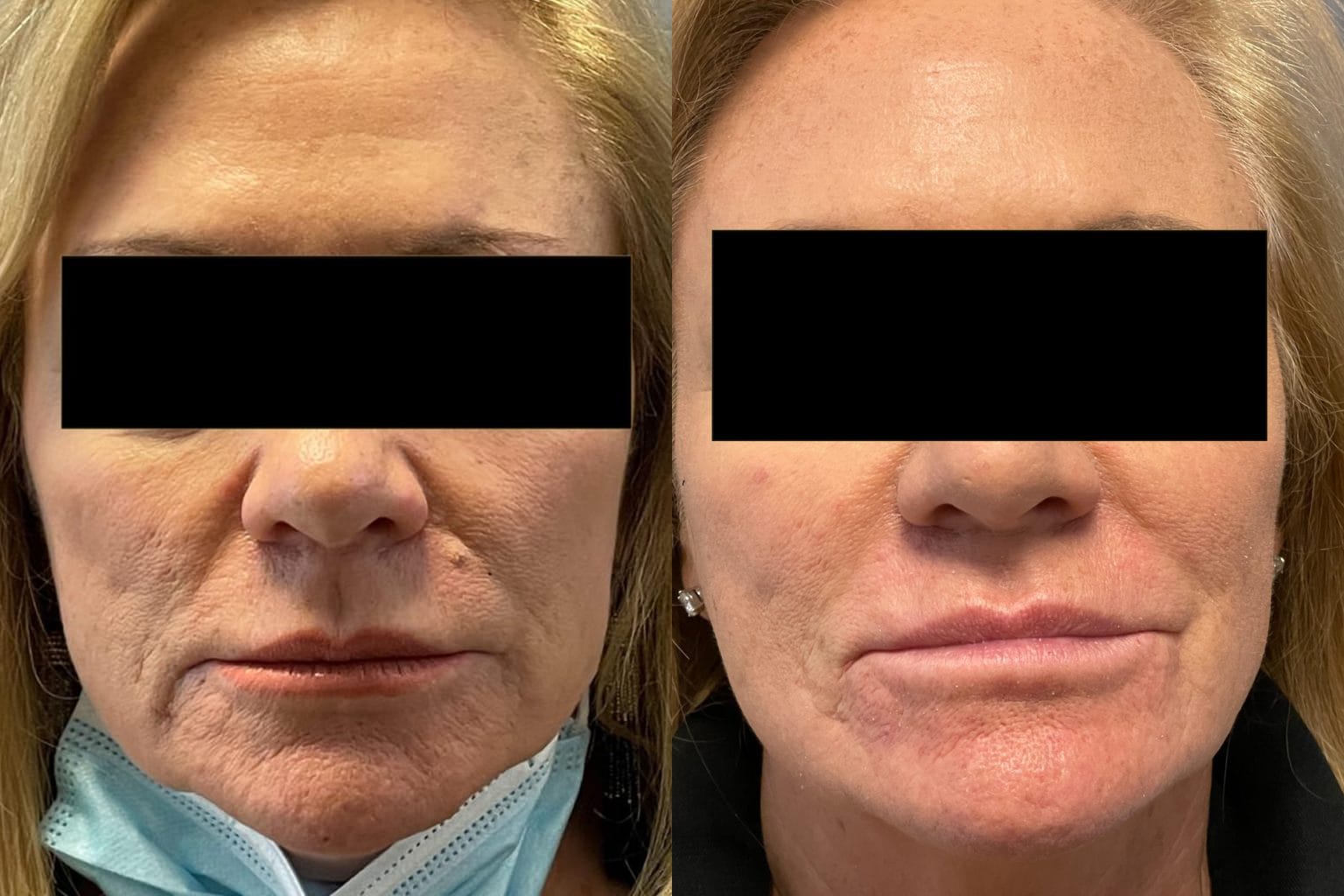 Before and After Image: Dermal Fillers - front